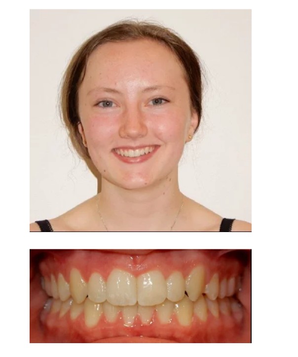 Invisalign after 