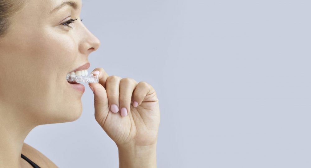 clear aligners adelaide