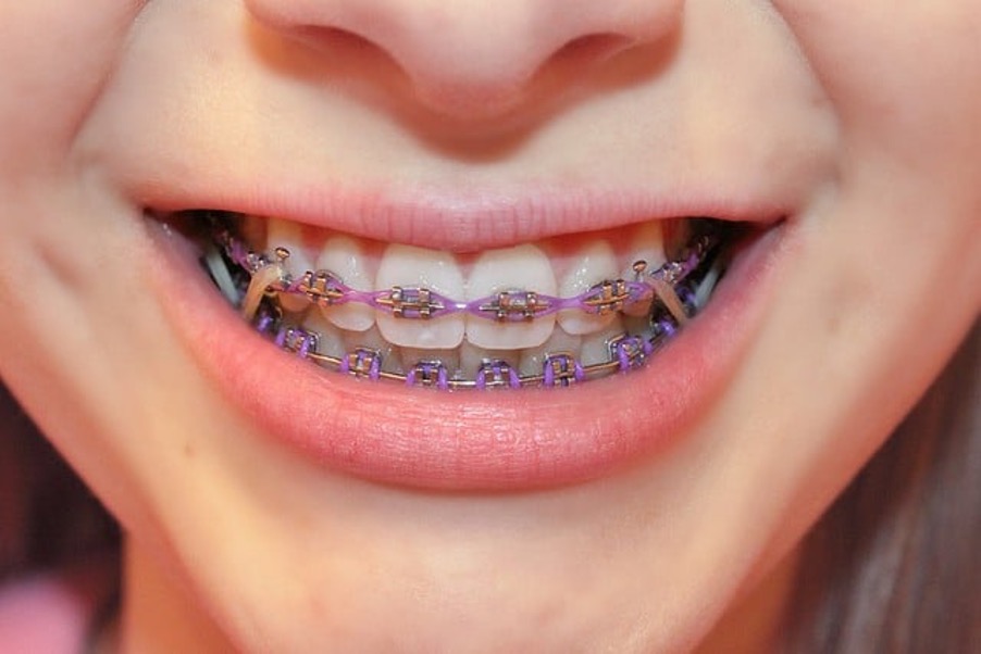 braces elastics